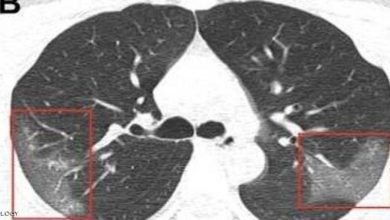 صورة “السكانير” لكشف الإصابة بـ “كورونا”.. خبير مغربي يشرح لـ “سيت أنفو”